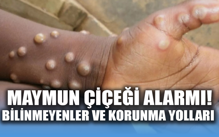 Maymun Çiçeği Alarmı! İşte bilinmeyenler ve korunma yolları 